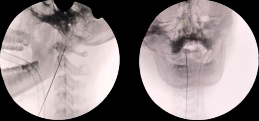 以技「稳」颈:17 岁少年意外颈椎骨折,3 cm 微创切口高难度「修」颈