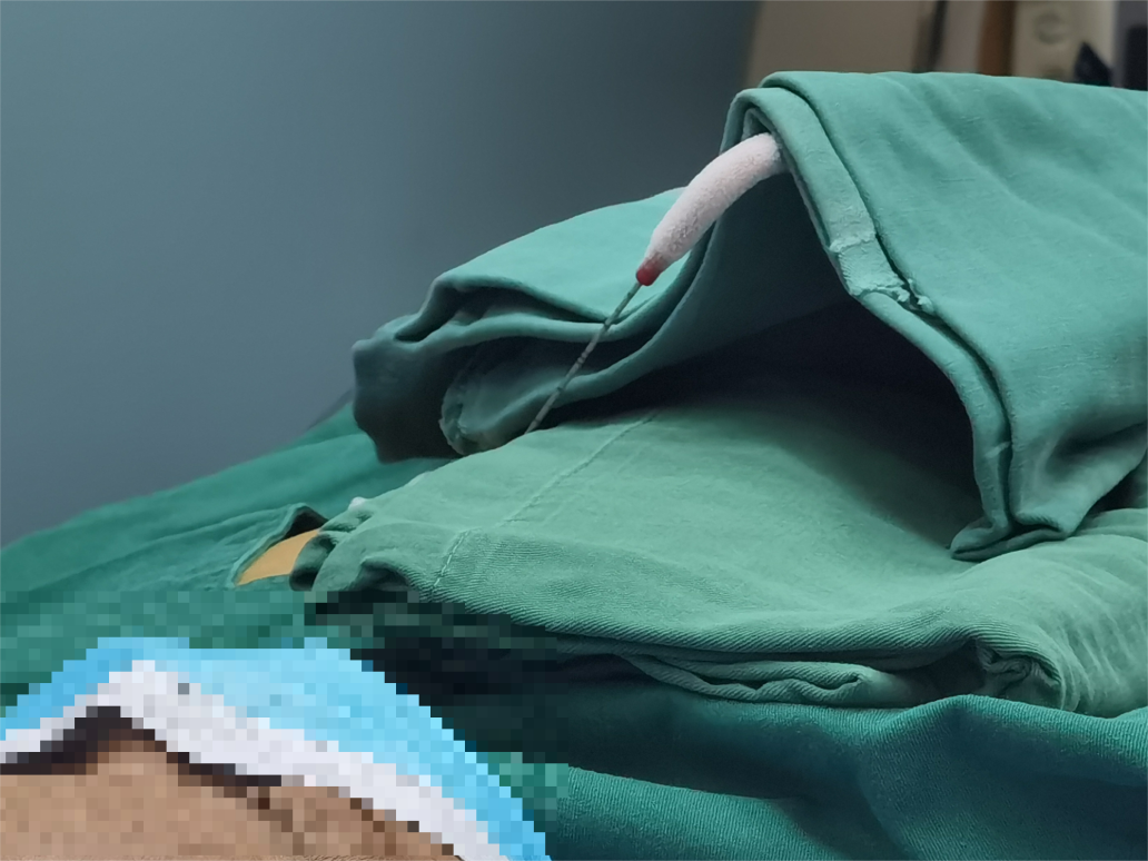 冷热交替 「杀灭」肿瘤!桂林医科大学一附院应用氩氦刀冷冻消融术治疗肺腺癌