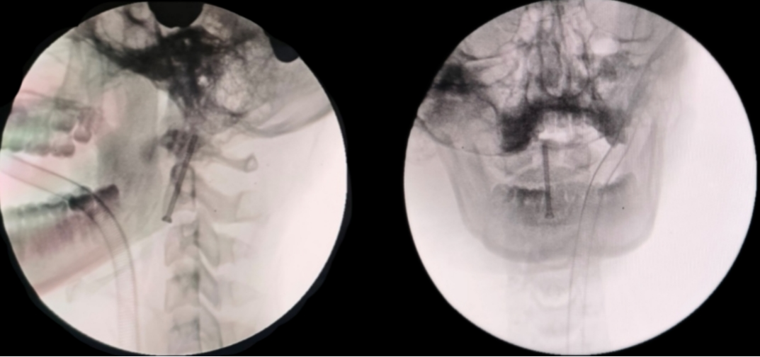 以技「稳」颈:17 岁少年意外颈椎骨折,3 cm 微创切口高难度「修」颈
