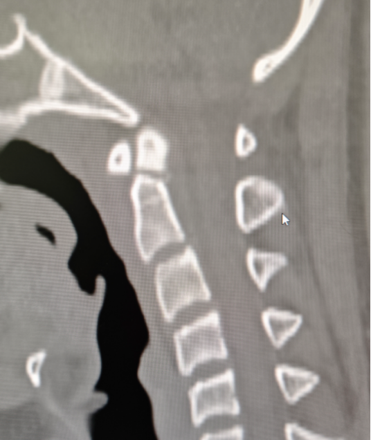 以技「稳」颈:17 岁少年意外颈椎骨折,3 cm 微创切口高难度「修」颈