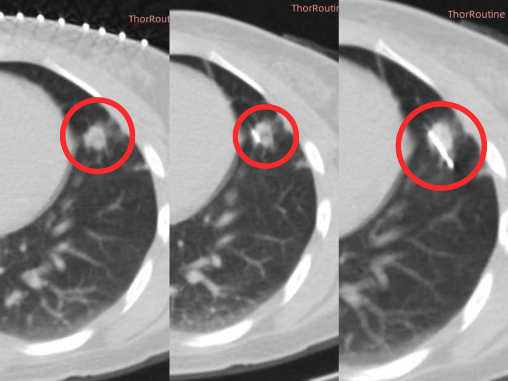 冷热交替 「杀灭」肿瘤!桂林医科大学一附院应用氩氦刀冷冻消融术治疗肺腺癌