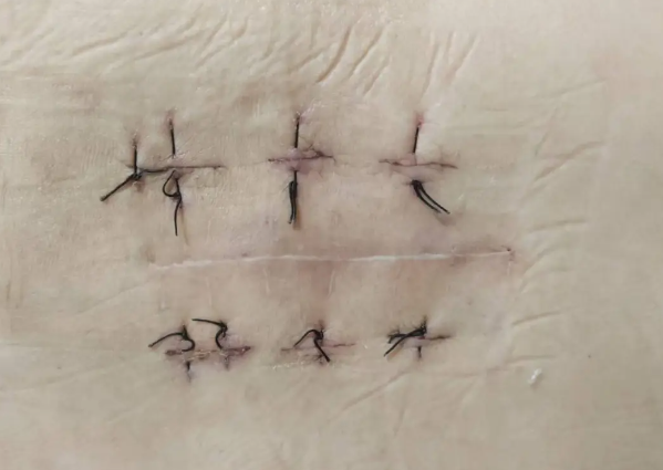 术后腰腿痛依旧?医生提醒:可能是这些原因