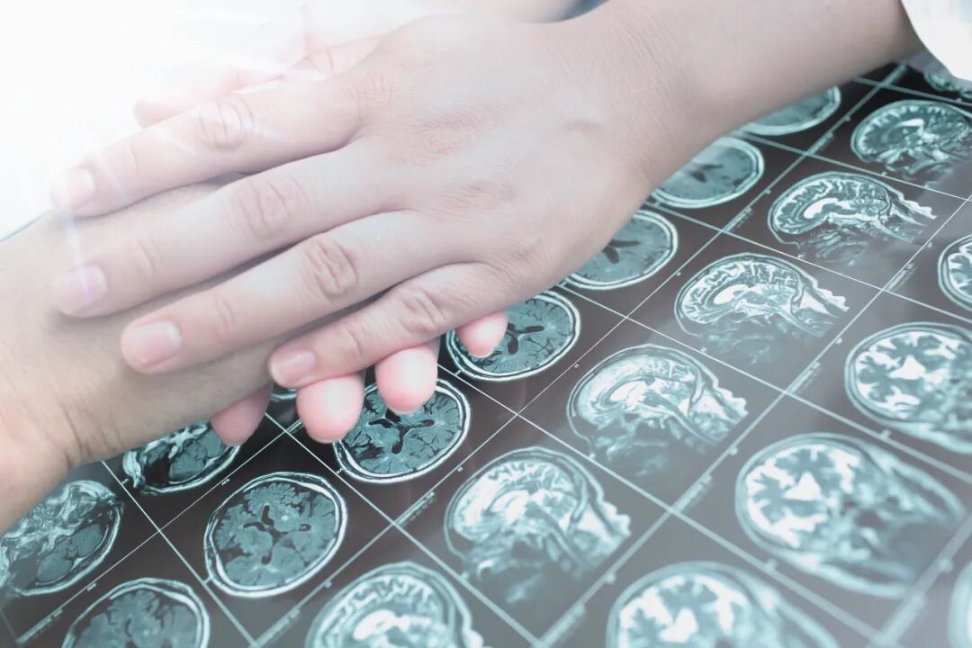 脑动脉瘤不是肿瘤,一旦「引爆」却比肿瘤凶险,突发头痛等症状,要警惕!