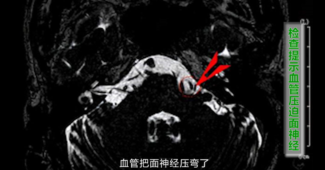 女子面抽眼皮跳 8 年余,医生感慨再晚就没治了,详解面肌痉挛的重要知识!