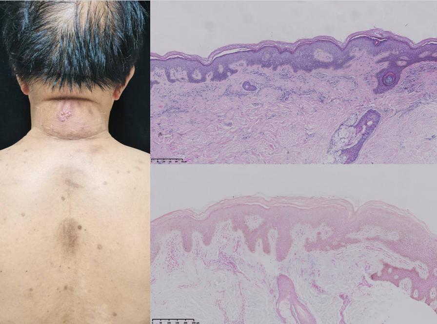 西安交大二附院联合疗法成功诊治罕见糖尿病性硬肿症
