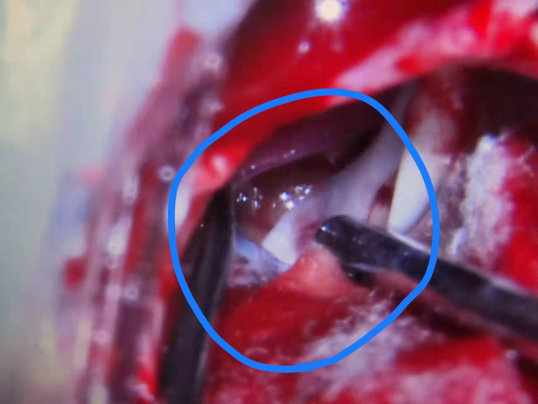 女子面抽眼皮跳 8 年余,医生感慨再晚就没治了,详解面肌痉挛的重要知识!