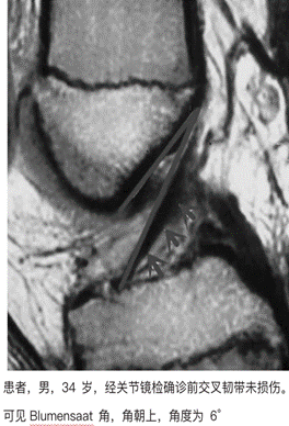 【高尚病例】前交叉韧带损伤 MR 征象