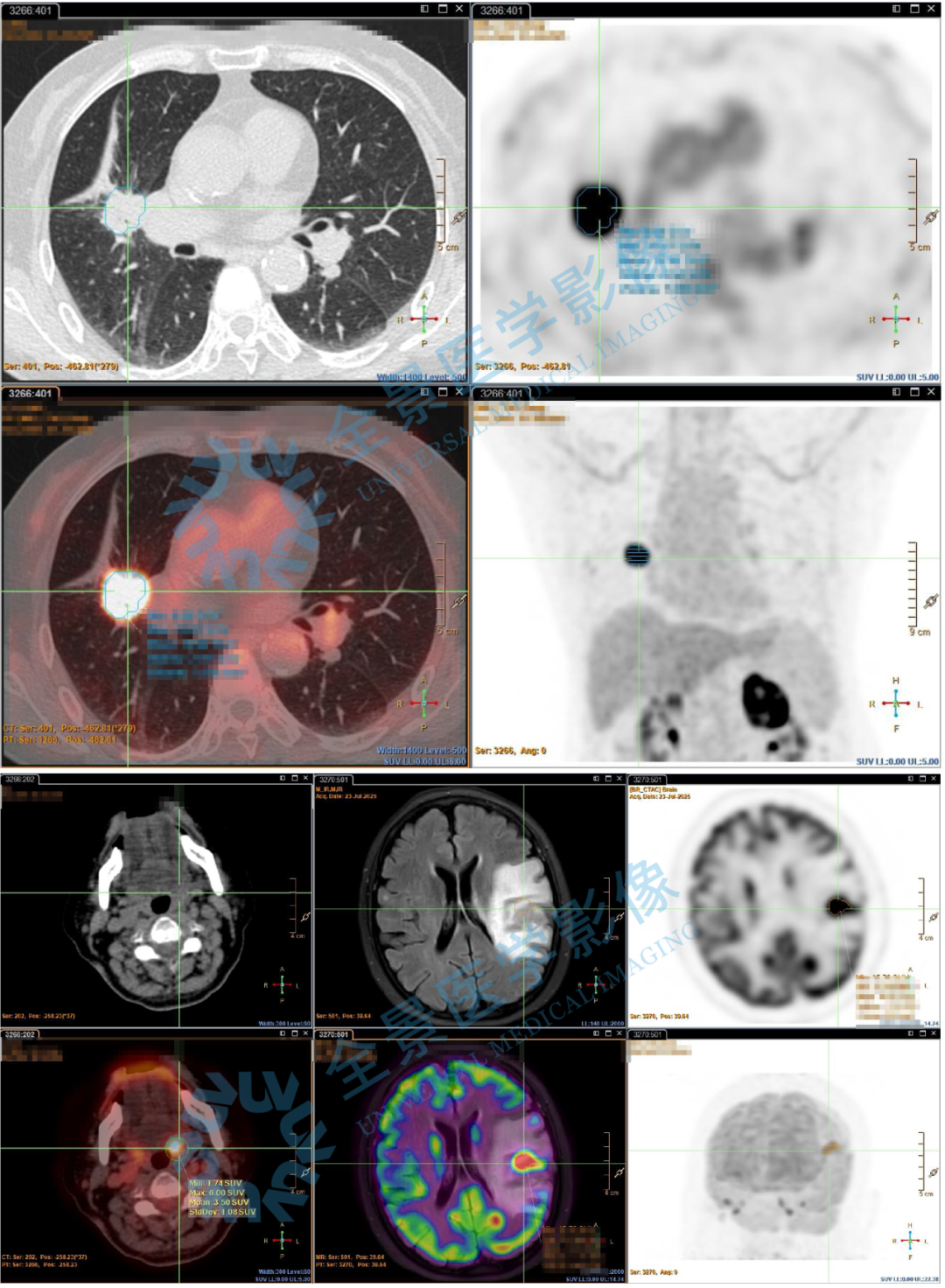 以为大脑问题，结果牵出肺癌……PET 多模态还原疾病发展过程