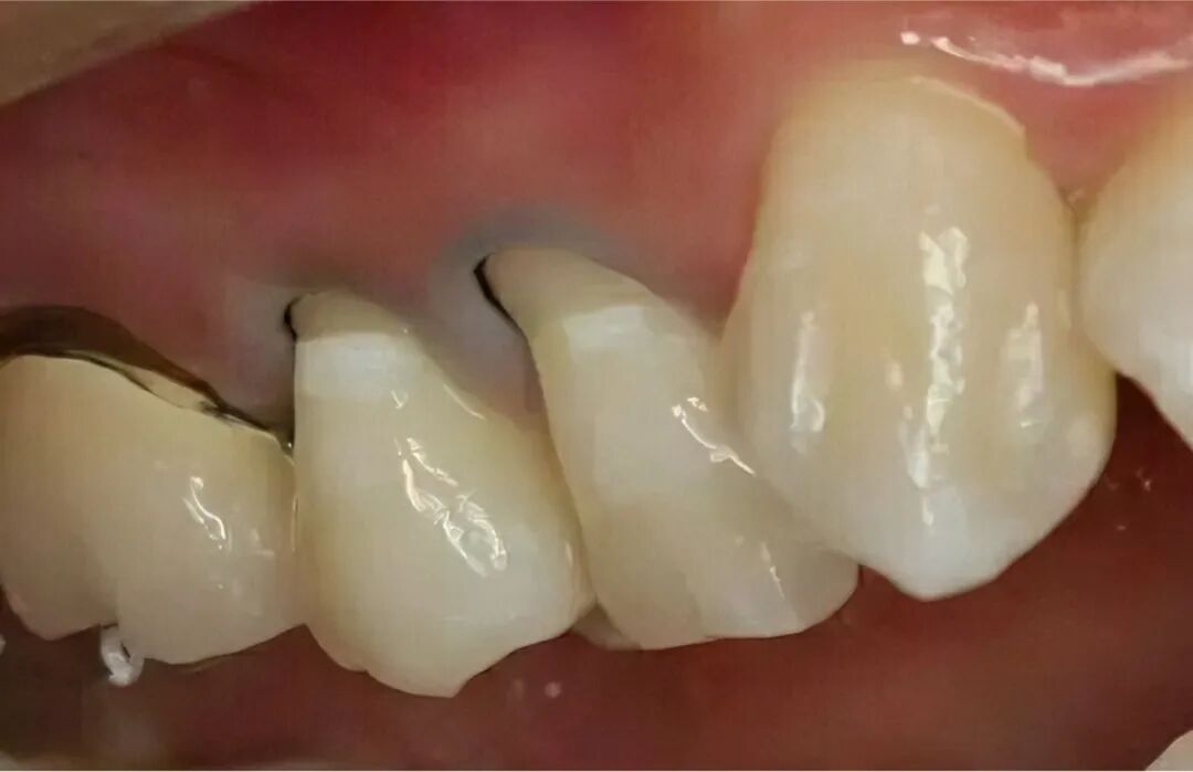 冷热酸甜都受不了！牙齿敏感是怎么造成的？