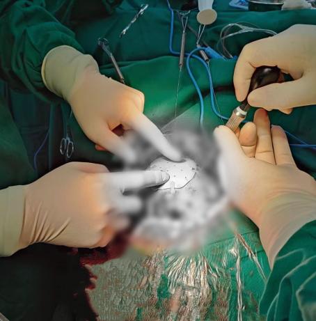 无锡顾连医院首例颅骨修补手术圆满成功!