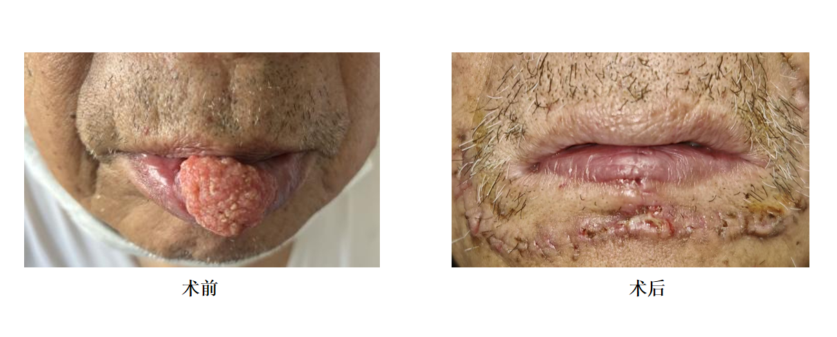 80 岁老人唇边「米粒」拖 10 年成癌 中南医院专家提醒:口腔异常别忽视