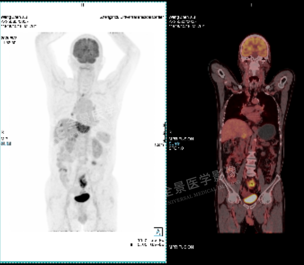 从「胃不舒服」到「肿瘤晚期」，只用了两周