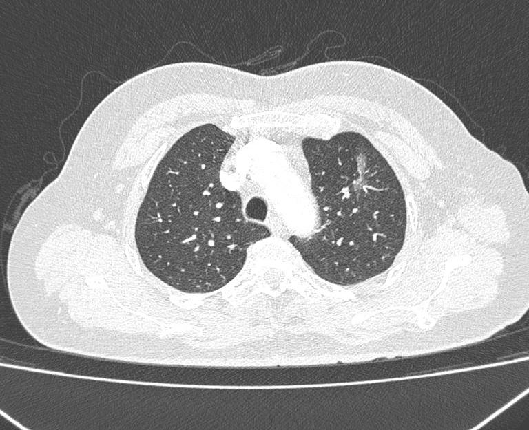 三年精准随访！黄山华泽医院肺结节诊治中心全力守护呼吸健康！