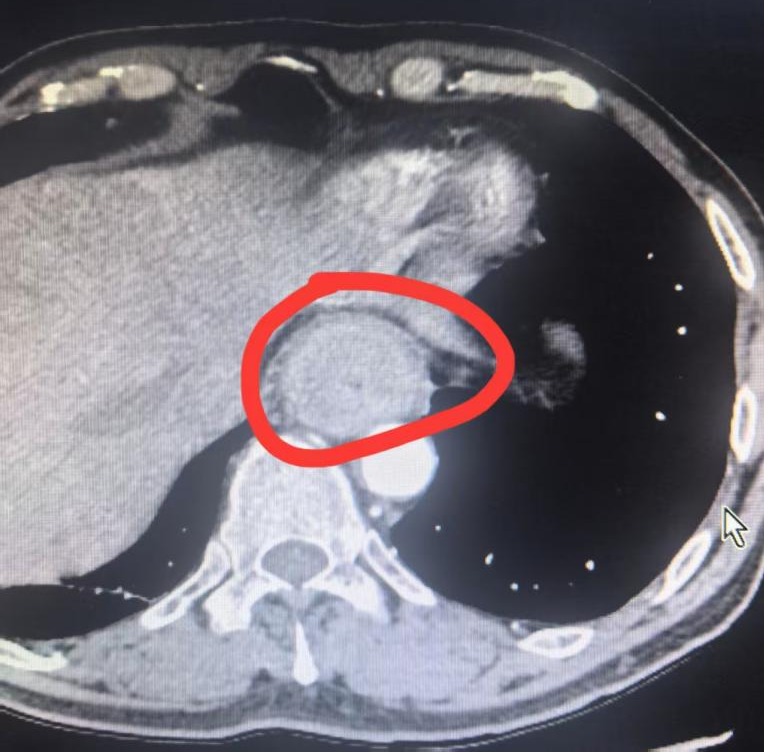 桂林医科大二附院胸腹腔镜手术助力食管肿瘤患者治疗更舒适