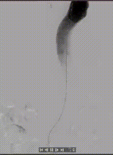 3D 打印「导航」精准开窗丨南京江北医院心脏大血管外科成功救治复杂腹主动脉瘤患者