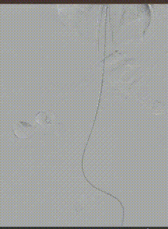 3D 打印「导航」精准开窗丨南京江北医院心脏大血管外科成功救治复杂腹主动脉瘤患者