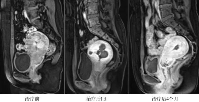 聚焦超声消融手术后肌瘤会变成「石头」吗？