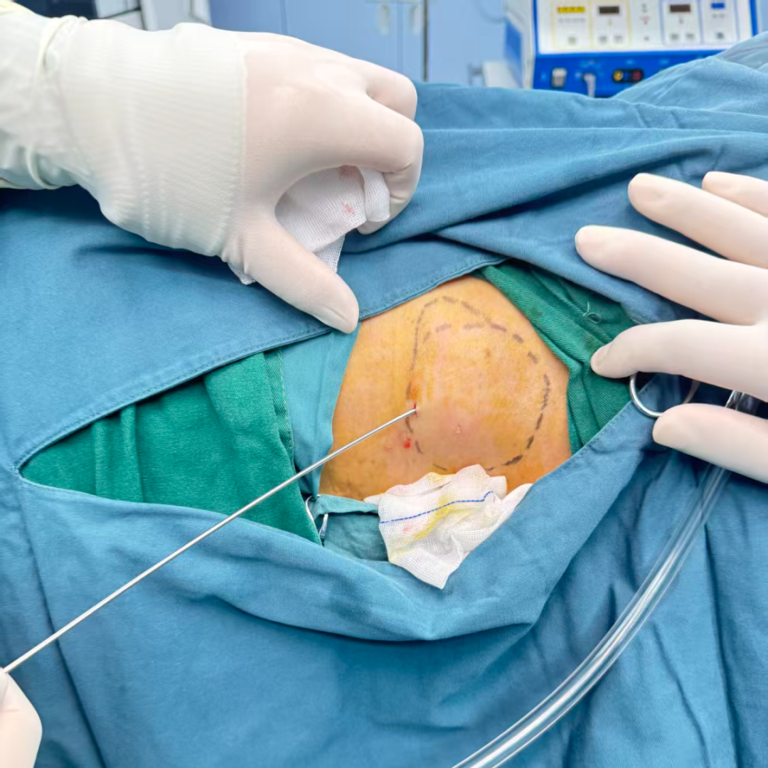 告别「蜈蚣疤」！脂肪瘤微创术：一个针眼，「吸」走烦恼