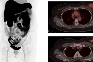 新型 HER2 靶向 PET/CT 显像技术，让乳腺癌 HER2 靶点「无处可藏」