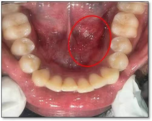 一吃饭就肿痛，七旬太婆患上「吃饭恐惧」？医生巧手疏通颌下腺通道