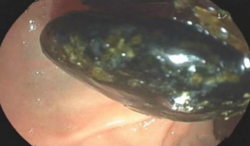 行百里者绊「久石」！百岁爷爷胆管藏「炸弹」，消化内镜微创拆隐患