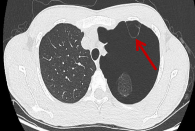 告别「插管」苦！无插管麻醉手术：微创又减痛，让快速康复照进现实