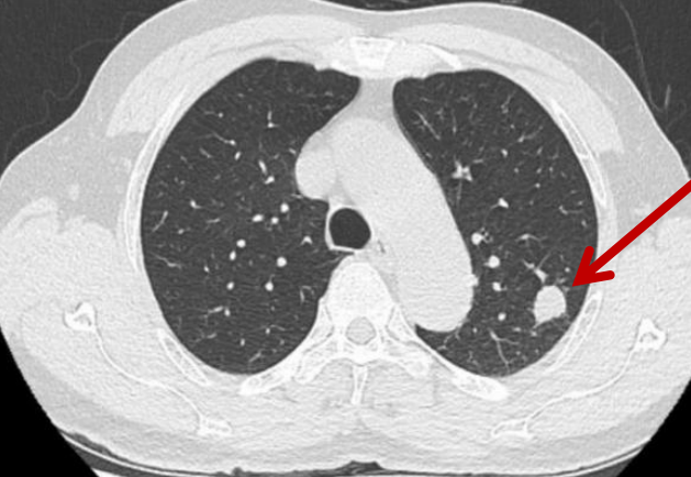 告别「插管」苦！无插管麻醉手术：微创又减痛，让快速康复照进现实