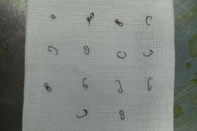 足足 14 枚「钉子」扎在屁股里！36 岁男子坐立不安