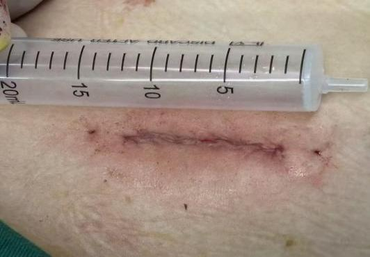 告别「插管」苦！无插管麻醉手术：微创又减痛，让快速康复照进现实