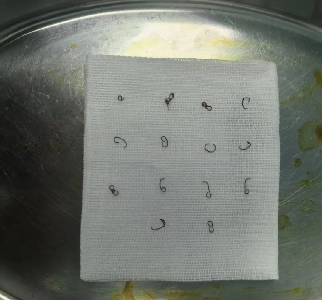 足足 14 枚「钉子」扎在屁股里!36 岁男子坐立不安