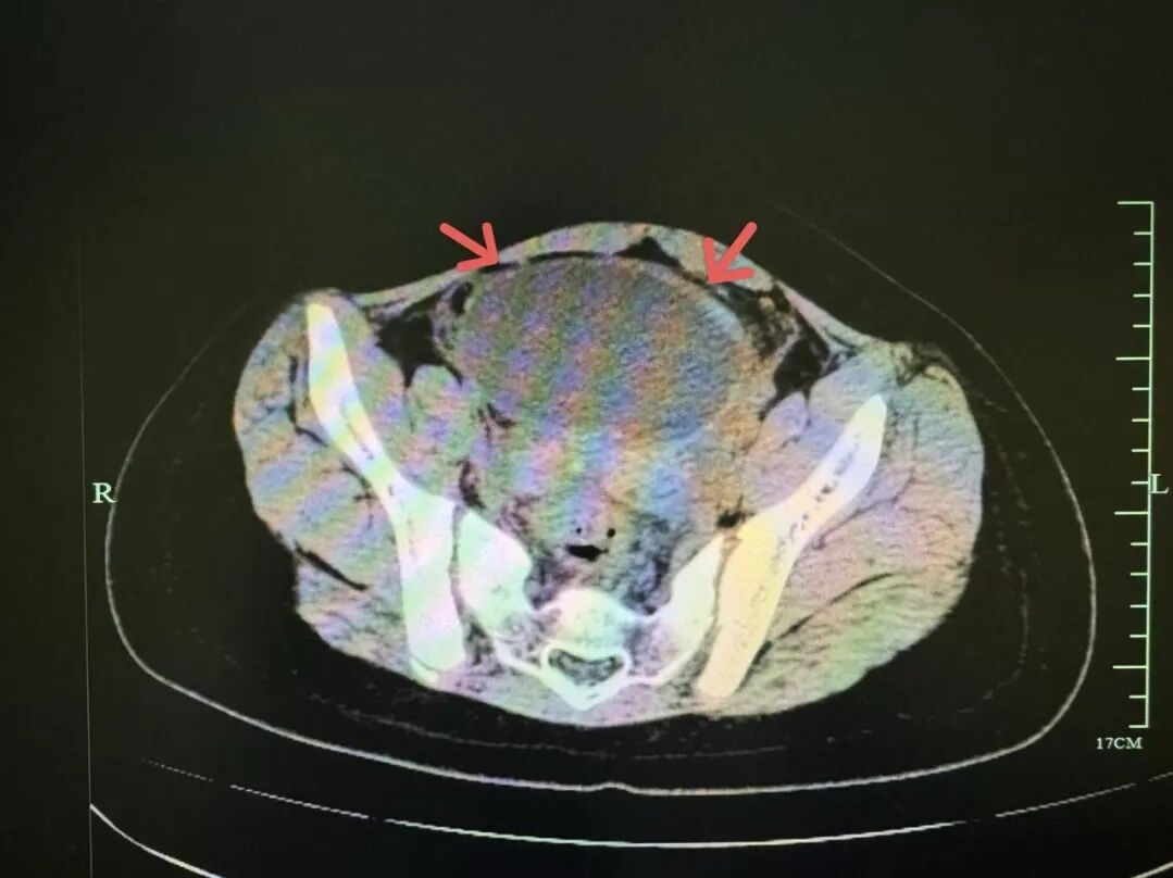 女孩喊肚子痛，查出 9.5 cm 体内「炸弹」！医生：这三种「腹痛」一刻也不能等