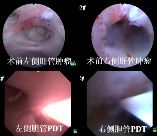 四次胆道手术仍陷困境！交大一附院东院区光动力治疗，为肝硬化+胆管肿瘤患者 「保肝除瘤」