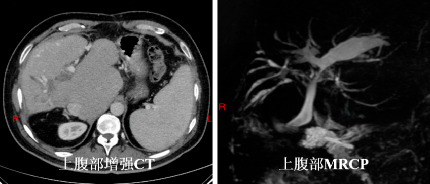 四次胆道手术仍陷困境！交大一附院东院区光动力治疗，为肝硬化+胆管肿瘤患者 「保肝除瘤」