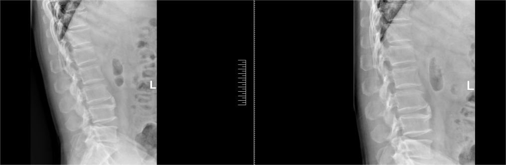 腰间盘突出微创术后康复的正确打开方式