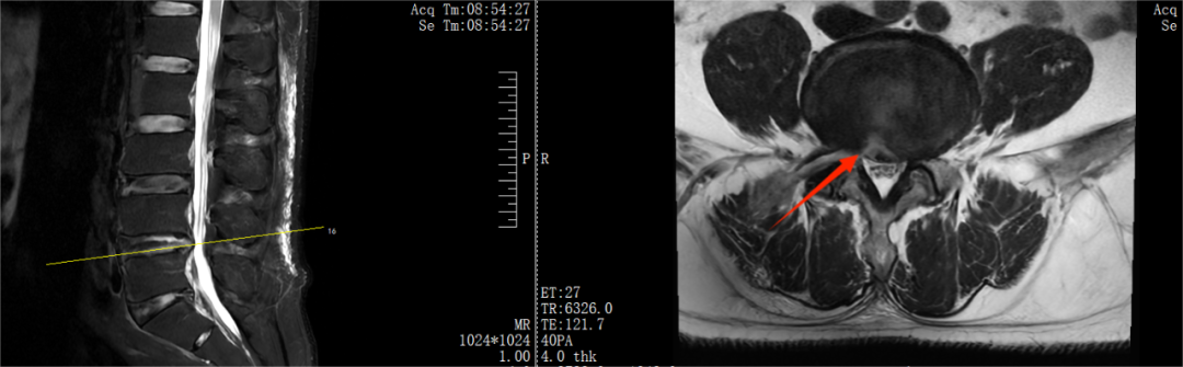 腰间盘突出微创术后康复的正确打开方式