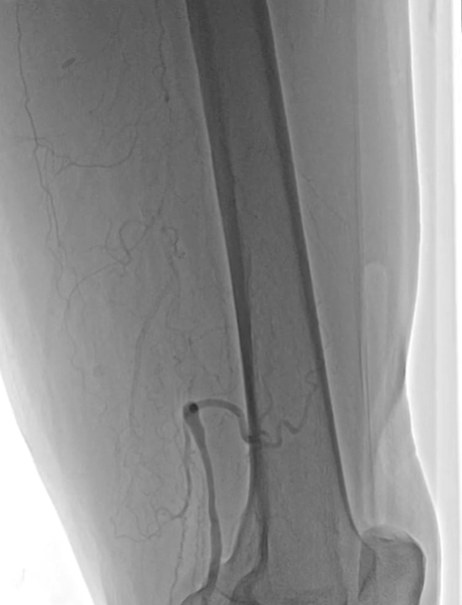 告别「腿梗」，西安市中医医院心血管病医院成功开展下肢动脉斑块旋切术