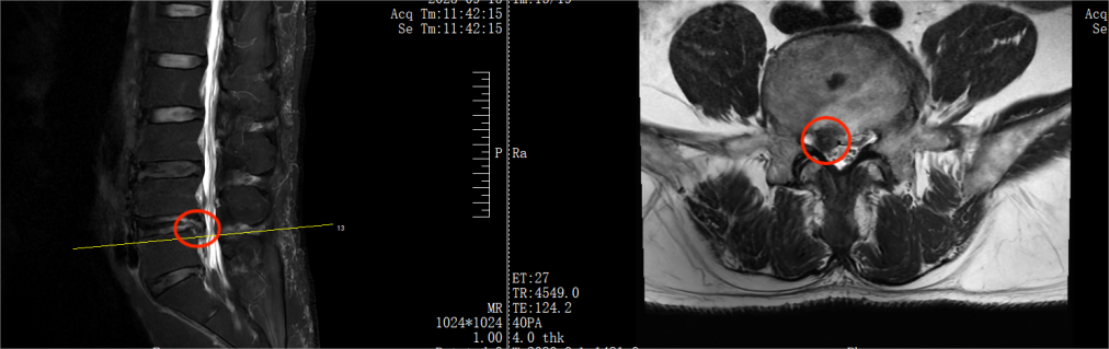 腰间盘突出微创术后康复的正确打开方式