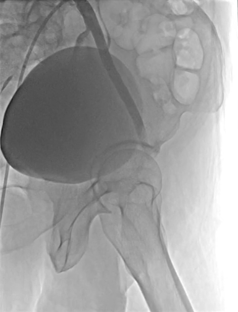 告别「腿梗」，西安市中医医院心血管病医院成功开展下肢动脉斑块旋切术