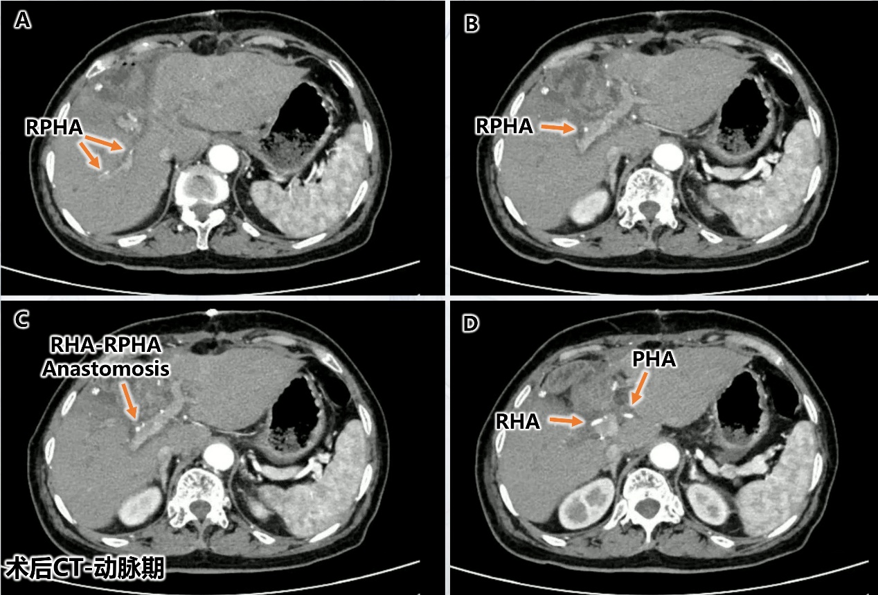 【高难度技术融合】——南昌大学二附院肝胆胰外科团队成功完成一例联合围肝门切除及肝动脉切除重建胆囊癌根治术