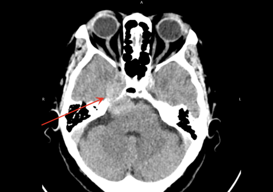 妙手破颅底禁区,仁心护患者健康——四川蓝生脑科医院神经外科成功切除颅底海绵窦区肿瘤
