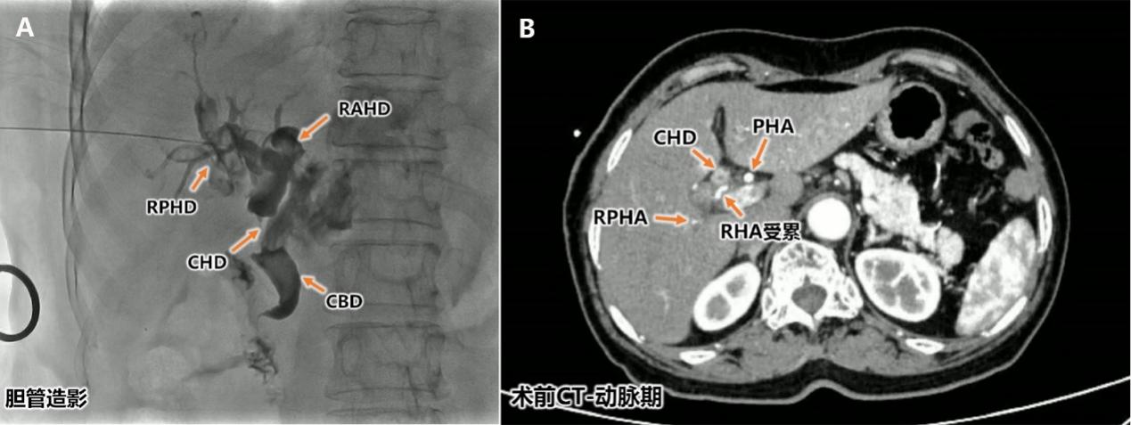 【高难度技术融合】——南昌大学二附院肝胆胰外科团队成功完成一例联合围肝门切除及肝动脉切除重建胆囊癌根治术