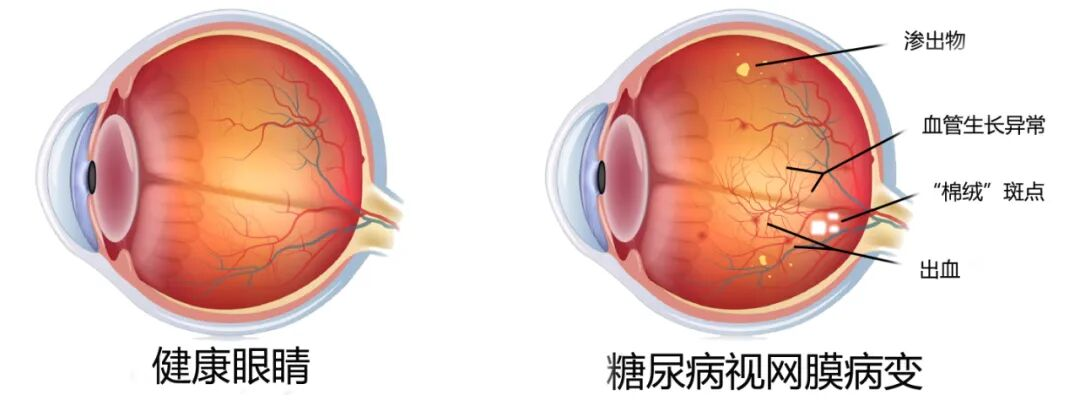 这些人群需警惕糖尿病视网膜病变?武汉普瑞眼科专家带来建议
