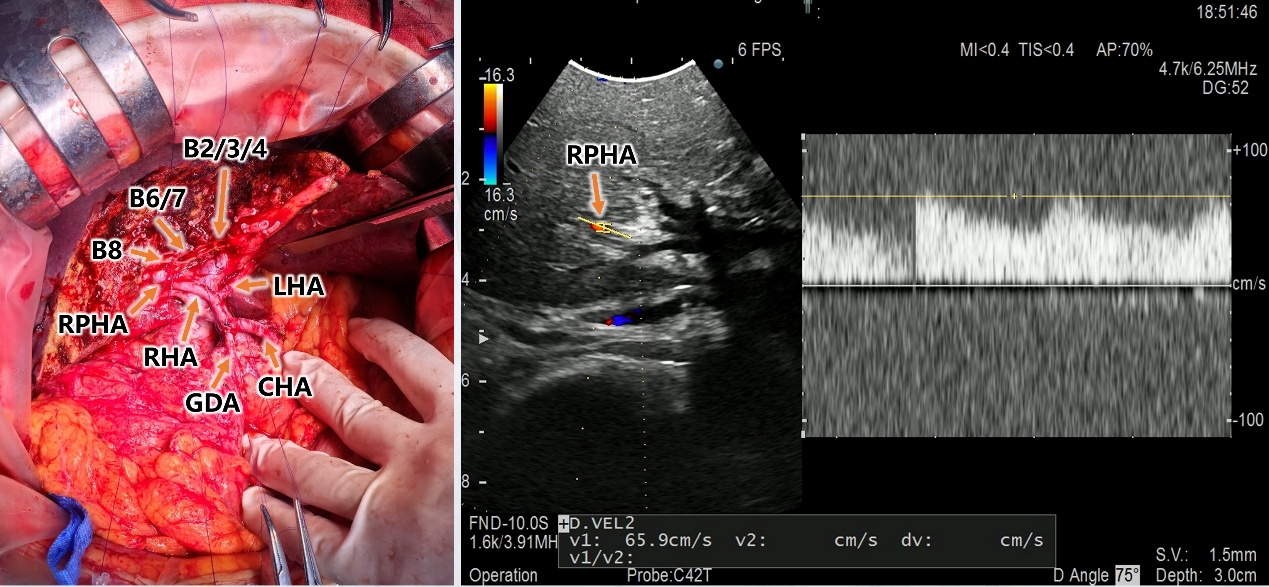 【高难度技术融合】——南昌大学二附院肝胆胰外科团队成功完成一例联合围肝门切除及肝动脉切除重建胆囊癌根治术