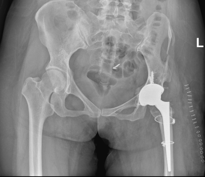 「解锁」三十年「锁死」的髋关节