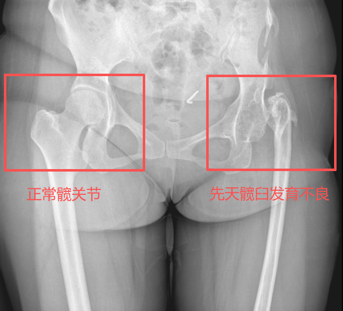 「解锁」三十年「锁死」的髋关节
