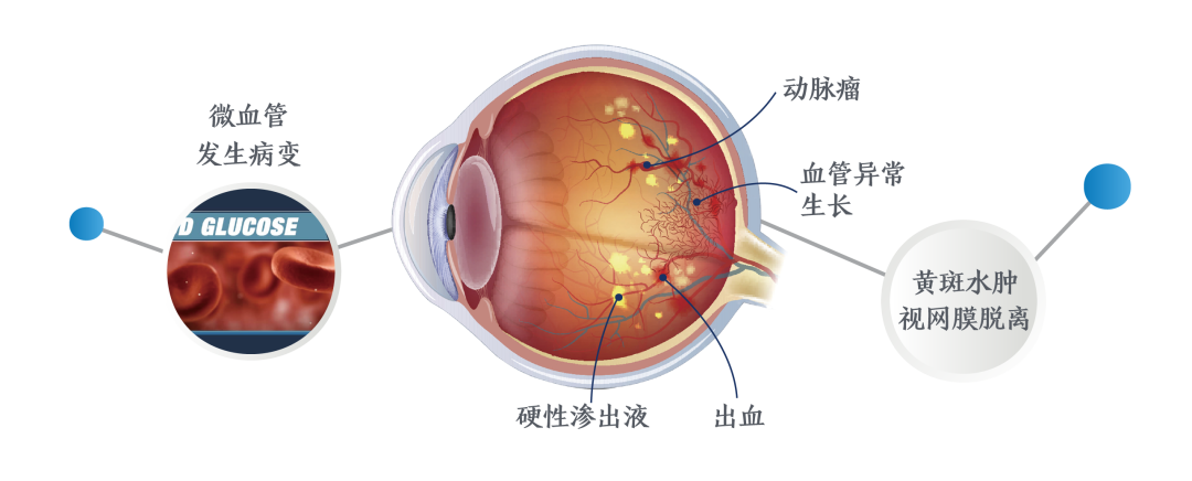 这些人群需警惕糖尿病视网膜病变?武汉普瑞眼科专家带来建议
