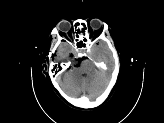 妙手破颅底禁区,仁心护患者健康——四川蓝生脑科医院神经外科成功切除颅底海绵窦区肿瘤