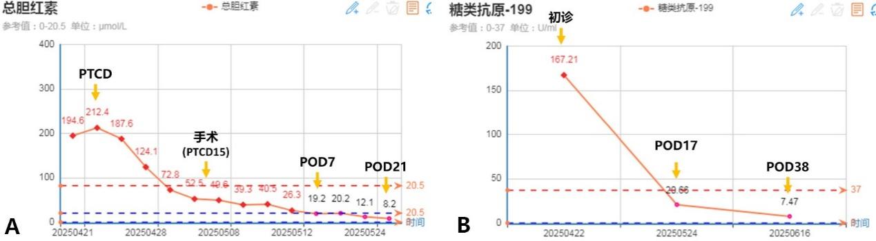 【高难度技术融合】——南昌大学二附院肝胆胰外科团队成功完成一例联合围肝门切除及肝动脉切除重建胆囊癌根治术
