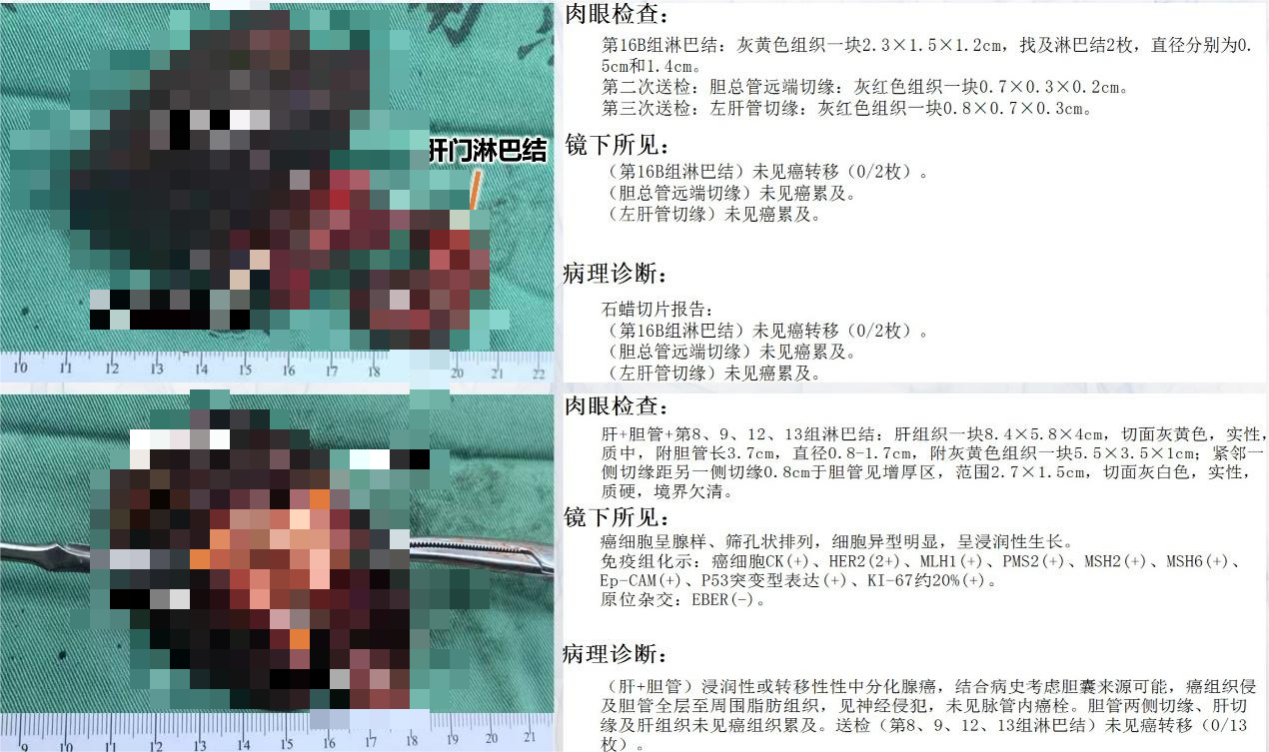 【高难度技术融合】——南昌大学二附院肝胆胰外科团队成功完成一例联合围肝门切除及肝动脉切除重建胆囊癌根治术