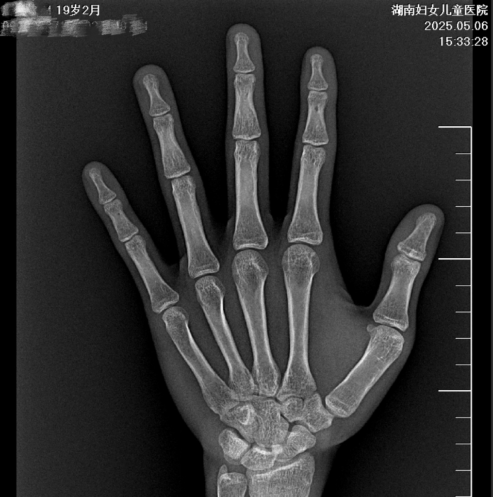 【儿童体检】19 岁男孩从未做过骨龄监测,未达到理想身高认为自己只是晚发育,结果造成一生遗憾